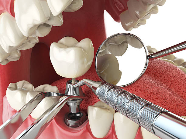 Best Emergency Dental Care for Abscessed Tooth in Huntgburg, IN
